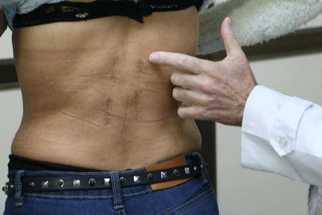 Novedosa operación de columna en el hospital central de San Isidro