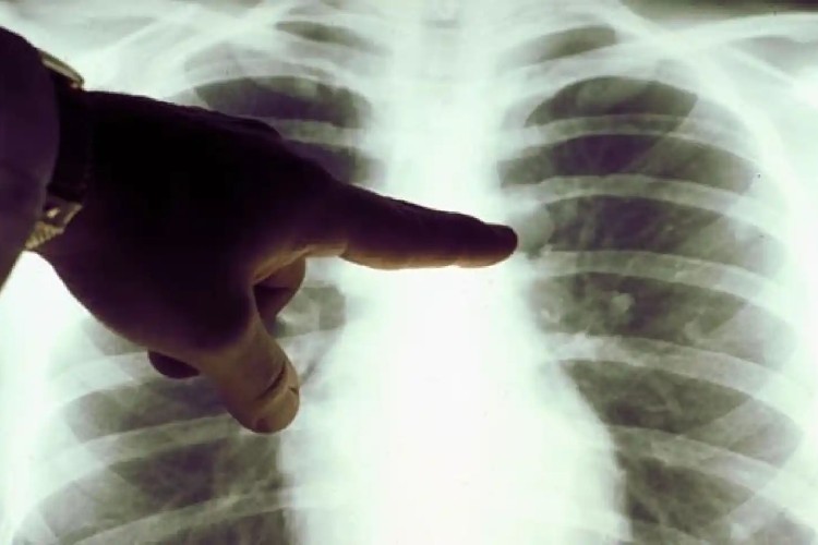 Fármaco contra el cáncer de pulmón reduce la tasa de progresión en un 34%, según estudio
